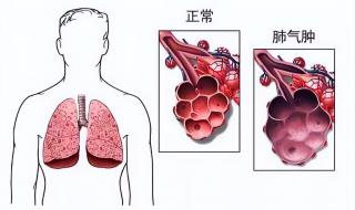 肺气肿是什么病严重吗 什么是肺气肿严重吗
